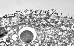 jejunum - celiakia